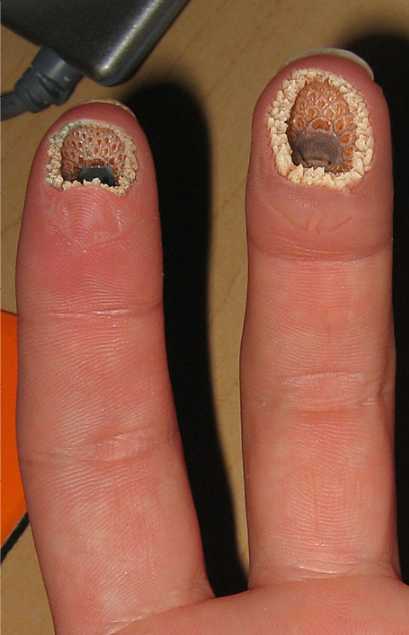 gross fingers